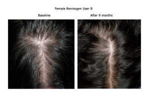 Female B Before & After