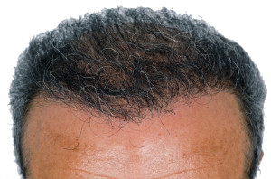 male pattern baldness Hair Transplants, Revivogen